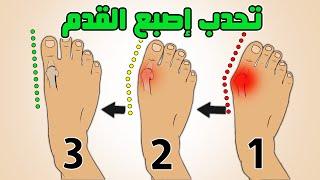 ألم اصبع القدم الكبير || علاج انحراف وتورم وخشونة عظمة ابهام القدم bunions  hallux valgus