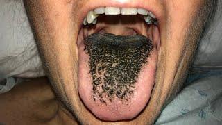 BLACK HAIRY TONGUE?! How To Get Rid Of It 