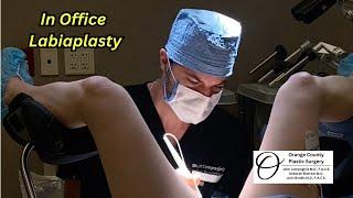 In Office Labiaplasty | Orange County Plastic Surgery #plasticsurgeon