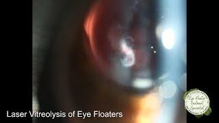 INACCESSIBLE EYE FLOATERS? USING A MIRRORED LENS