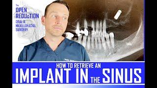 DENTAL IMPLANT FALLS INTO the SINUS | HOW TO RETRIEVE with CALDWELL LUC APPROACH | OMFS