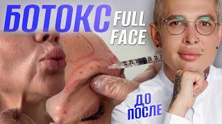 КАК КОЛОТЬ БОТОКС ПРАВИЛЬНО | FULL FACE ! НЕ колите БОТОКС пока не посмотрите это видео! #ботокс