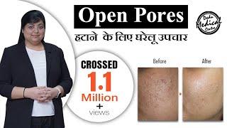 Home Remedies for Open Pores (In Hindi) | Open Pores Treatment by Dermatologist | Dr. Nivedita Dadu