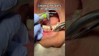 Dental Implant Surgery procedure incisor extraction implant drilling implant placed #dentalimplants