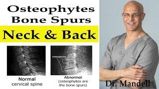 Do Bone Spurs/Osteophytes in Neck & Back Go Away? -  Dr Alan Mandell, DC