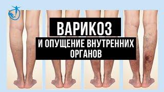 Взаимосвязь ВАРИКОЗА, ОТЕКОВ, ТЯЖЕСТИ в ногах с ОПУЩЕНИЕМ внутренних органов // Владимир Животов