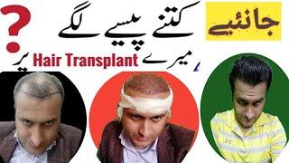 Hair transplant price in Pakistan | hair transplant cost | hair transplant results in Pakistan