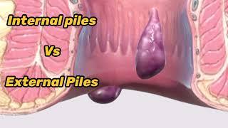 BAADI BAVASIR Vs Khooni Bawasir ? Which are different types of Piles & Haemorrhoids ? Piles meaning
