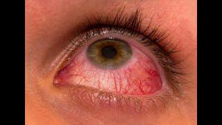  Что делать, когда краснеют глаза - гиперемии.