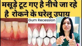 मसूड़े नीचे जा रहे है,टूट गए है,रोकने के लिए घरेलु इलाज।Home Remedies For Gum Recession