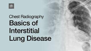 Chest Radiography: Basics of Interstitial Lung Disease