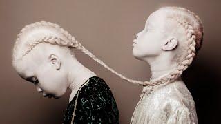 «Темнокожие альбиносы»: как сейчас выглядят уникальные сестры-близнецы Лара и Мара Бавар