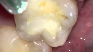 Long lasting tooth colored fillings - Five year old composite fillings