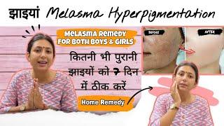 कितनी भी पुरानी झाइयों को 7 दिन में ठीक करें | Skin Care Remedy for Melasma Treatment