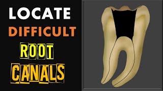 How to locate difficult root canals