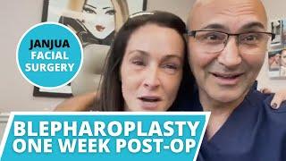 LOWER LID BLEPHAROPLASTY ONE WEEK POST-OP - DR. TANVEER JANJUA - NEW JERSEY