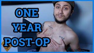 ONE YEAR POST-OP TOP SURGERY WITH MILES BERRY (FTM) | STEPH KYRIACOU