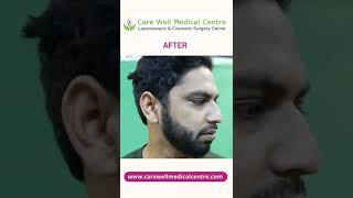 Beard Transplant Result Before and After - Beard Transplantation Amazing Results After 6 Month