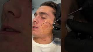 Atrophic Acne Scar Treatment with Dr. Qazi  #acnescarremoval