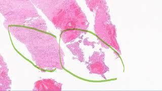 Well differentiated hepatocellular carcinoma vs benign hepatic proliferation