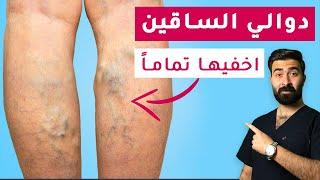 حل سريع ونهائي لمشكلة الدوالي  | أفضل طريقة لعلاج دوالي الساقين في المنزل !