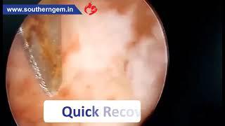 Hysteroscopy and Polyp Removal