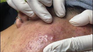 Acne treatment for Spa Linh Mun 2024 #34