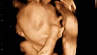 3D Ultrasound Video | 3D Sono Image