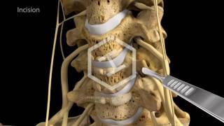 c5-c6-c7 Anterior Cervical Discectomy with Fusion