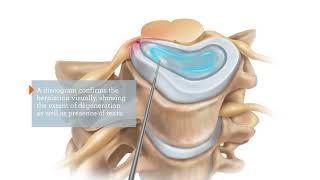 IntelliSpine Cervical Laser Procedure