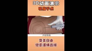 抽脂雕塑，腹部抽脂，3D动画演示，让您更了解手术过程