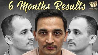 Best Hair Transplant Results in Grade 3 | Hair Transplant Surgery Month by Month Results in Delhi