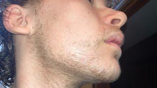 Minoxidil and Derma roller (Week 36) (Month 9)