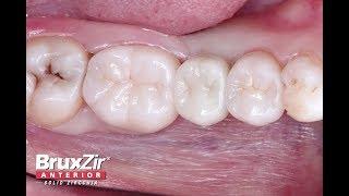 Chairside Live Episode 223: Protocol for Single-Tooth Implant Placement