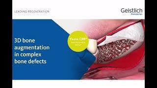 Yxoss CBR® and Geistlich Biomaterials