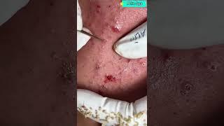 AlinSpa(72)_Acnes Mụn ú ù