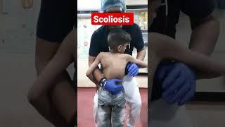 scoliosis treatment #drrajneeshkant