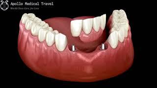 Animated Partial Fixed Denture Procedure | Apollo Medical Travel