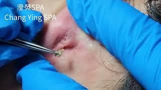 #shorts 在耳後的巨大黑頭 Take out a huge blackhead