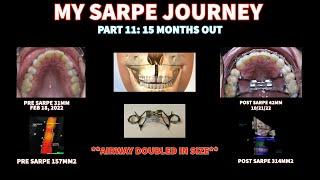 MY SARPE JOURNEY PART 11: 15 MONTHS OUT