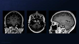 Translabyrinthine Craniotomy for Resection of a Vestibular Schwannoma