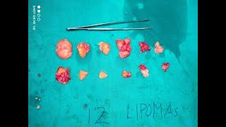 MINIMAL INVASIVE SURGERY FOR LIPOMA| SCARLESS LIPOMA SURGERY| COSMETIC SURGERY FOR LIPOMA REMOVAL