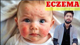 Eczema (एक्जिमा): Causes, Symptoms & Types | Atopic & Seborrheic Dermatitis Symptoms #facts