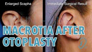 Correction of a Large Macrotia Ear Deformity