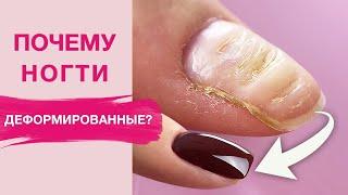 Deformed Nails | How to Fix and Strengthen with Polygel