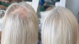 V-light hair extensions| alopecia / hair thinning~ hair extensions transformation