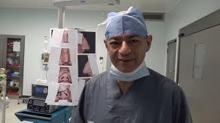 Septoplasty and Caudal Dislocation Correction-6: Rhinoplasty Bizrah- London/Dubai- Dr. Bashar Bizrah
