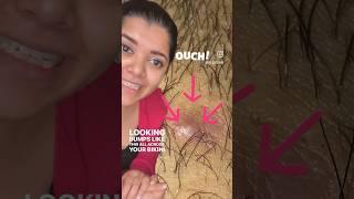 Pimples after shaving? DrCuterus explains