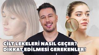 Cilt Lekeleri Nasıl Geçer? Dikkat Edilmesi Gerekenler ️