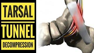 Tarsal Tunnel Decompression